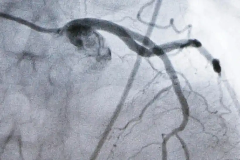 Experimental Cholesterol‑Lowering Pill May Offer New Option for Millions